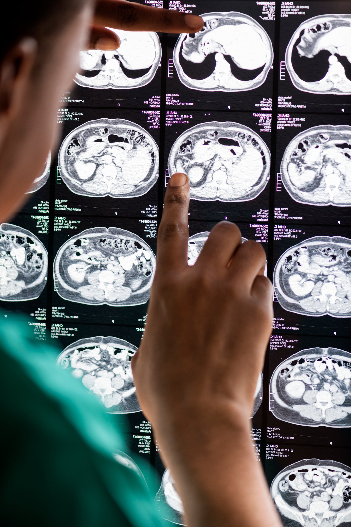 How Brain Tumour Symptoms Start