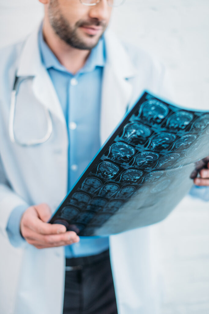 Doctor in a white coat holds a brain MRI film, closely examining the images.